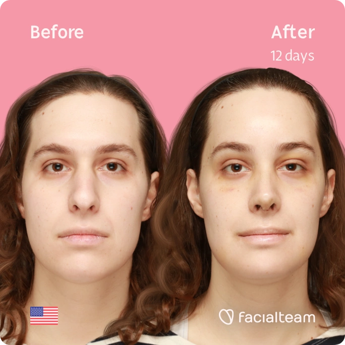 Square frontal image of FFS patient Robin showing the results before and after facial feminization surgery with Facialteam consisting of forehead, rhinoplasty and chin feminization.