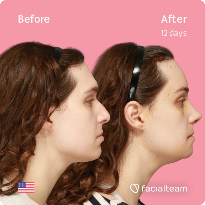Square side image of FFS patient Robin showing the results before and after facial feminization surgery with Facialteam consisting of forehead, rhinoplasty and chin feminization.