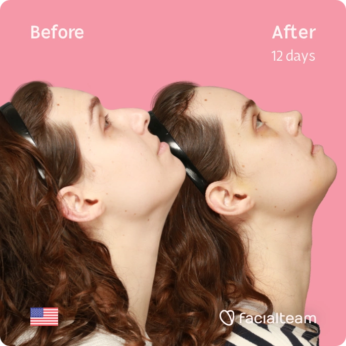Square side up image of FFS patient Robin showing the results before and after facial feminization surgery with Facialteam consisting of forehead, rhinoplasty and chin feminization.