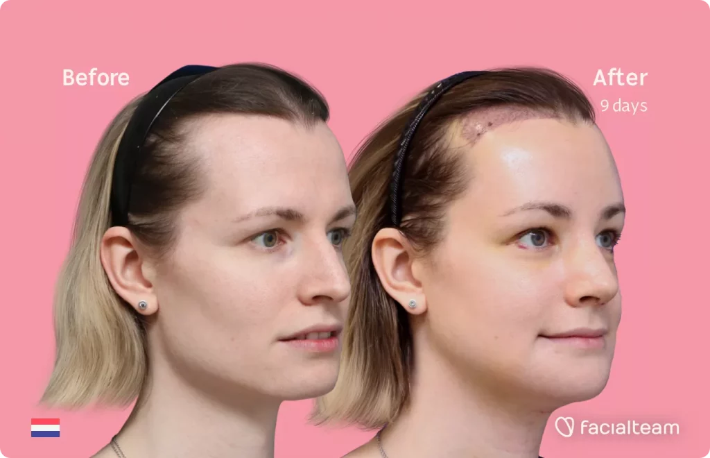 45 degree angle image of FFS patient Laura showing the results before and after facial feminization surgery with Facialteam consisting of forehead with SHT, jaw and chin feminization, tracheal shave and rhinoplasty.