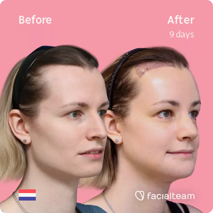 Square 45 degree angle image of FFS patient Laura showing the results before and after facial feminization surgery with Facialteam consisting of forehead with SHT, jaw and chin feminization, tracheal shave and rhinoplasty.