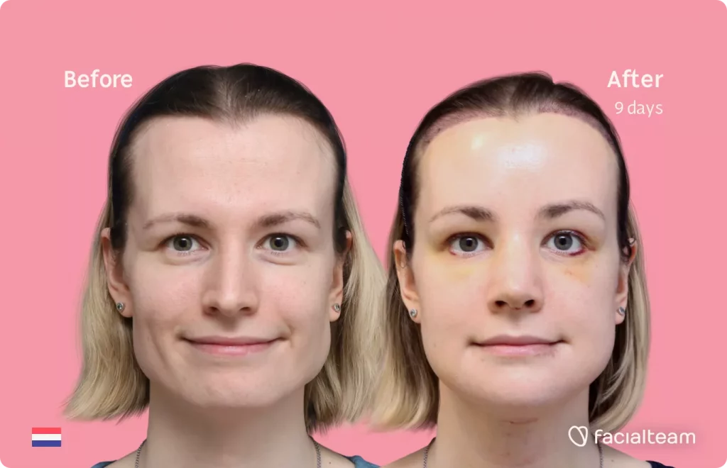 Frontal image of FFS patient Laura showing the results before and after facial feminization surgery with Facialteam consisting of forehead with SHT, jaw and chin feminization, tracheal shave and rhinoplasty.