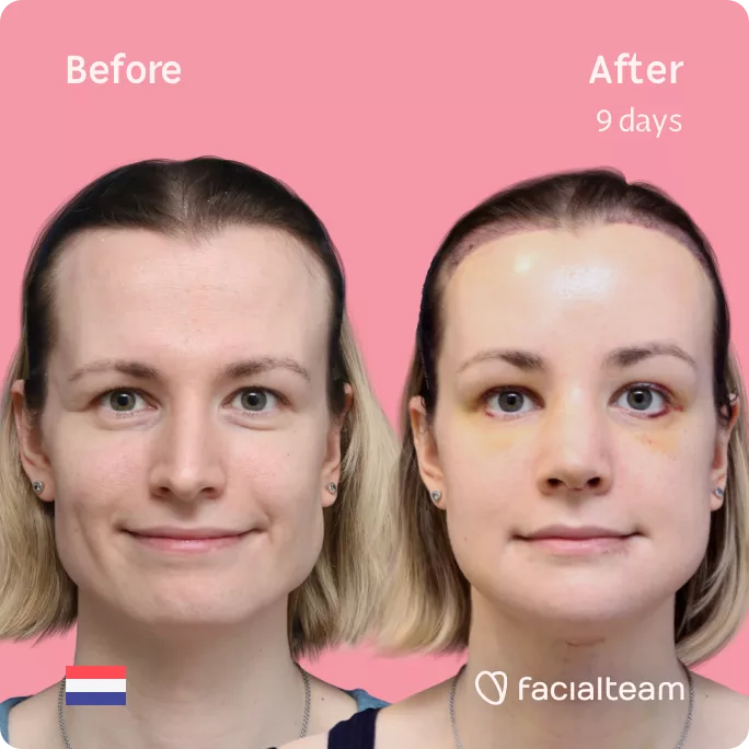 Square frontal image of FFS patient Laura showing the results before and after facial feminization surgery with Facialteam consisting of forehead with SHT, jaw and chin feminization, tracheal shave and rhinoplasty.