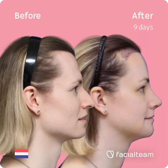 Square side image of FFS patient Laura showing the results before and after facial feminization surgery with Facialteam consisting of forehead with SHT, jaw and chin feminization, tracheal shave and rhinoplasty.