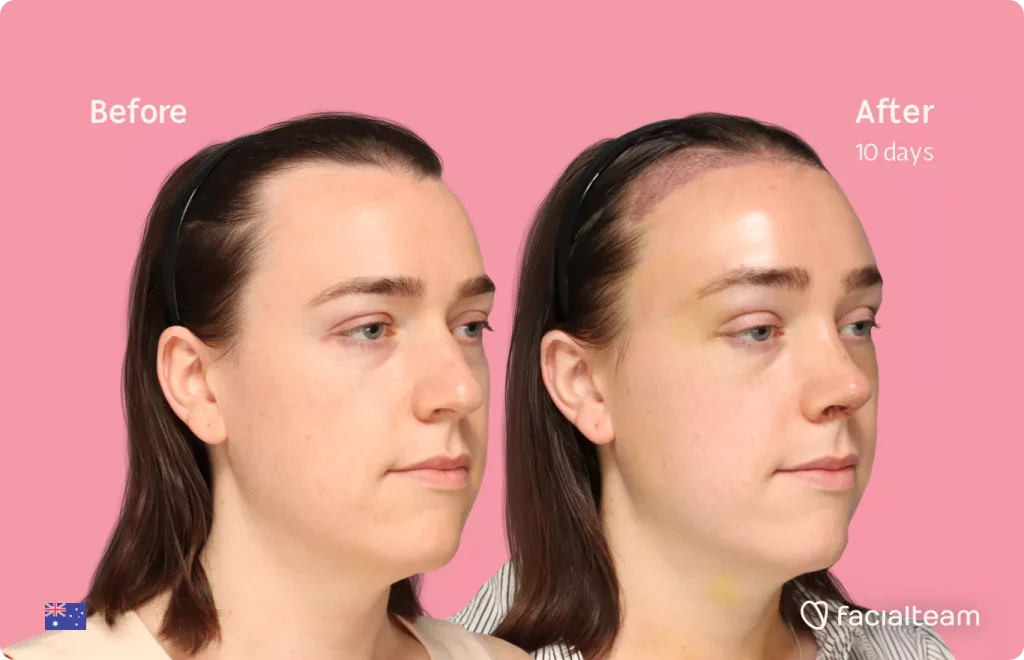 45 degree angle image of FFS patient Snow showing the results before and after facial feminization surgery with Facialteam consisting of forehead with SHT feminization and rhinoplasty.