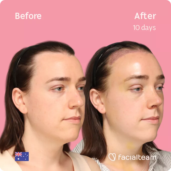 Square 45 degree angle image of FFS patient Snow showing the results before and after facial feminization surgery with Facialteam consisting of forehead with SHT feminization and rhinoplasty.