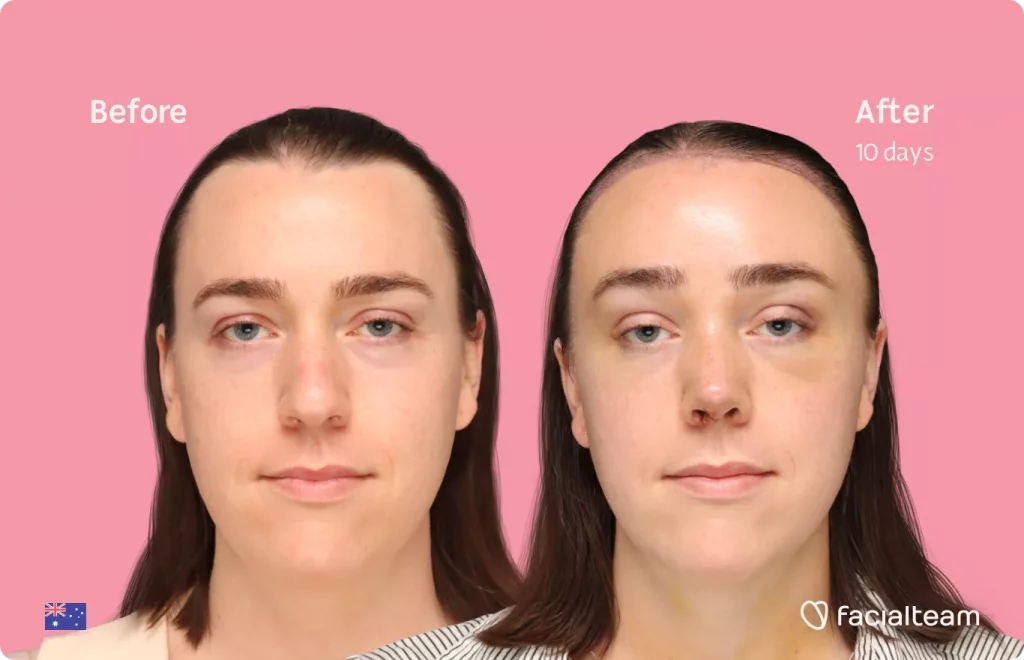 Frontal image of FFS patient Snow showing the results before and after facial feminization surgery with Facialteam consisting of forehead with SHT feminization and rhinoplasty.