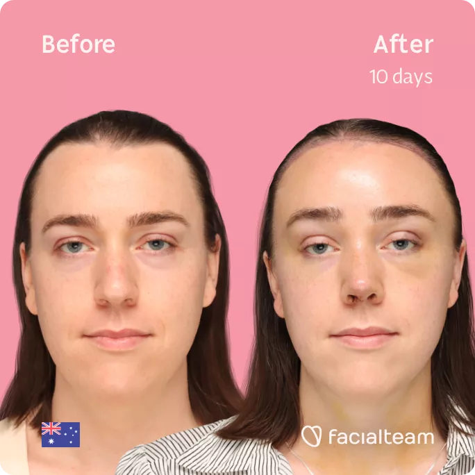 Square frontal image of FFS patient Snow showing the results before and after facial feminization surgery with Facialteam consisting of forehead with SHT feminization and rhinoplasty.