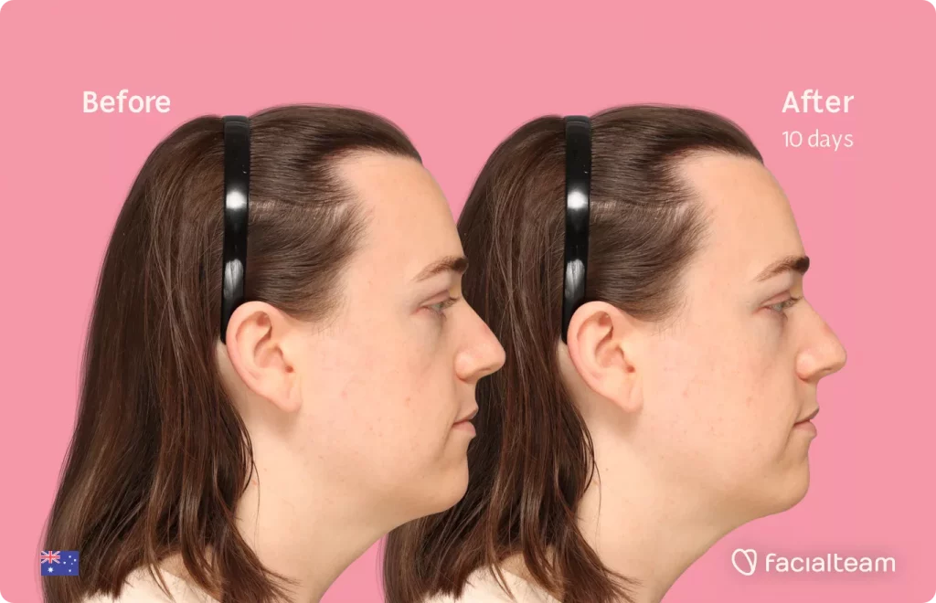 Side image of FFS patient Snow showing the results before and after facial feminization surgery with Facialteam consisting of forehead with SHT feminization and rhinoplasty.
