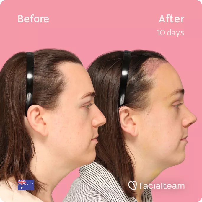 Square side image of FFS patient Snow showing the results before and after facial feminization surgery with Facialteam consisting of forehead with SHT feminization and rhinoplasty.