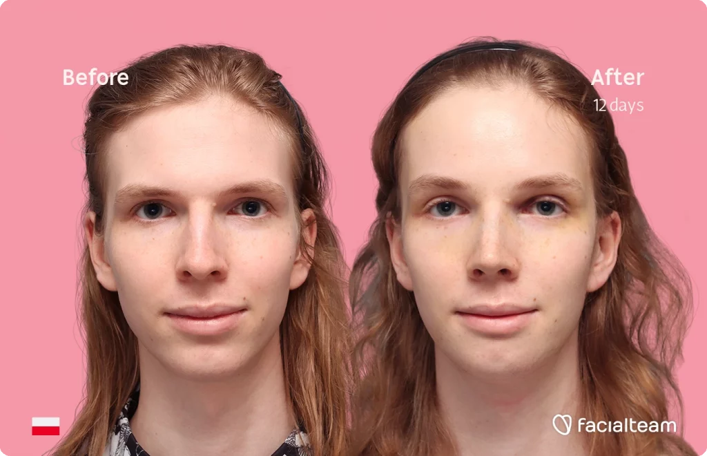 Frontal image of FFS patient Victoria W showing the results before and after facial feminization surgery with Facialteam consisting of forehead, rhinoplasty and chin feminization.