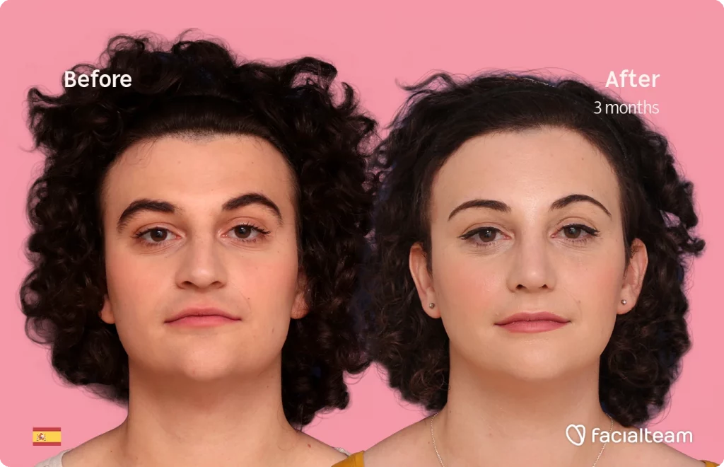 Frontal image of FFS patient Elizabeth showing the results before and after facial feminization surgery with Facialteam consisting of forehead, jaw and chin feminization and rhinoplasty.