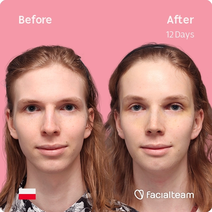 Square frontal image of FFS patient Victoria W showing the results before and after facial feminization surgery with Facialteam consisting of forehead, rhinoplasty and chin feminization.