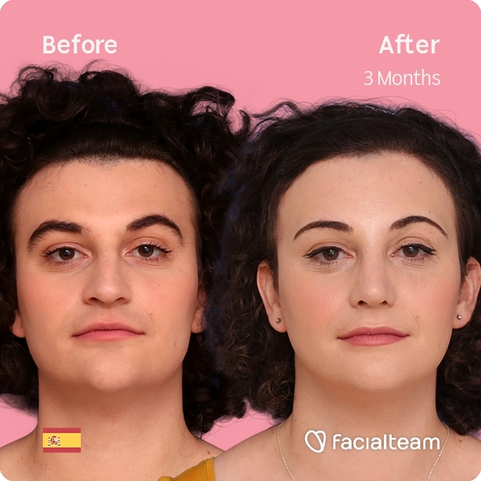 Square frontal image of FFS patient Elizabeth showing the results before and after facial feminization surgery with Facialteam consisting of forehead, jaw and chin feminization and rhinoplasty.