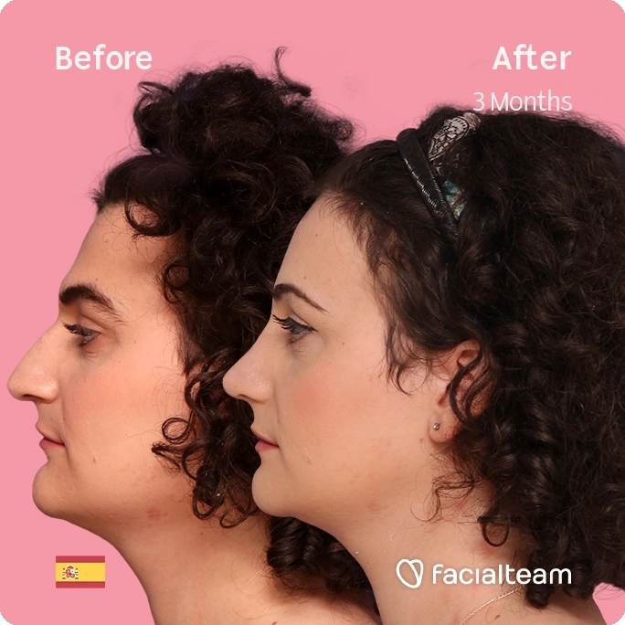 Square left side image of FFS patient Elizabeth showing the results before and after facial feminization surgery with Facialteam consisting of forehead, jaw and chin feminization and rhinoplasty.