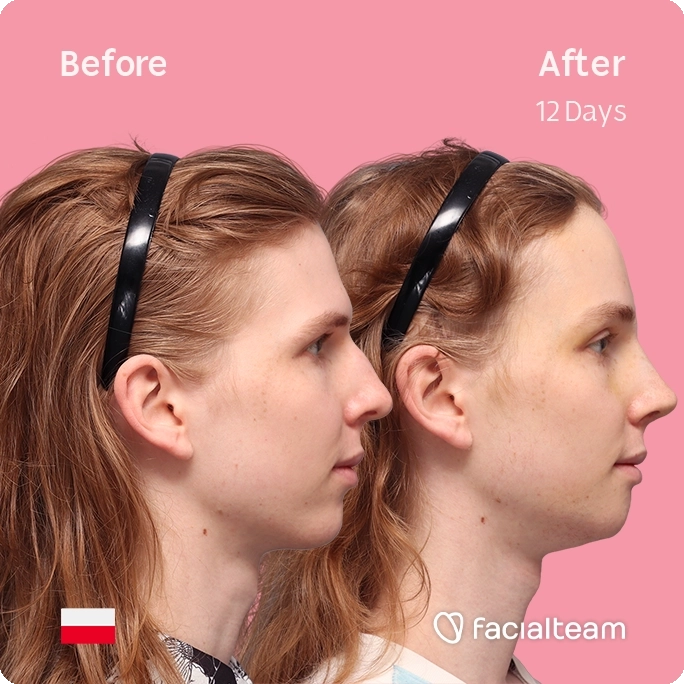 Square side image of FFS patient Victoria W showing the results before and after facial feminization surgery with Facialteam consisting of forehead, rhinoplasty and chin feminization.