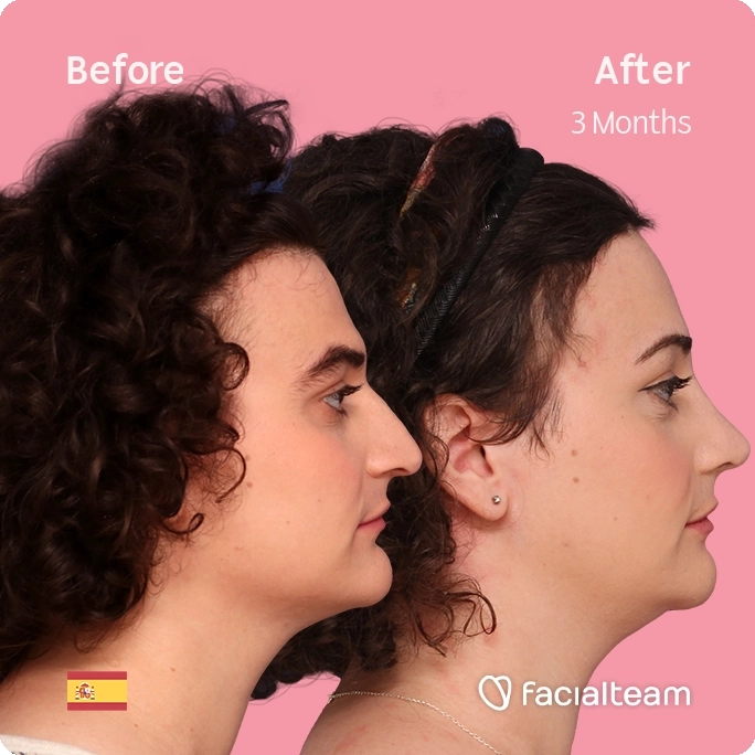 Square right side image of FFS patient Elizabeth showing the results before and after facial feminization surgery with Facialteam consisting of forehead, jaw and chin feminization and rhinoplasty.