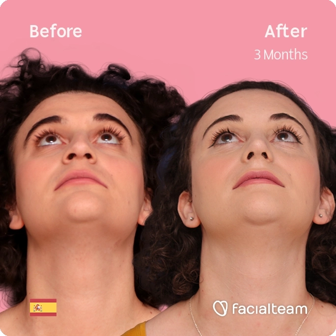 Square frontal up image of FFS patient Elizabeth showing the results before and after facial feminization surgery with Facialteam consisting of forehead, jaw and chin feminization and rhinoplasty.