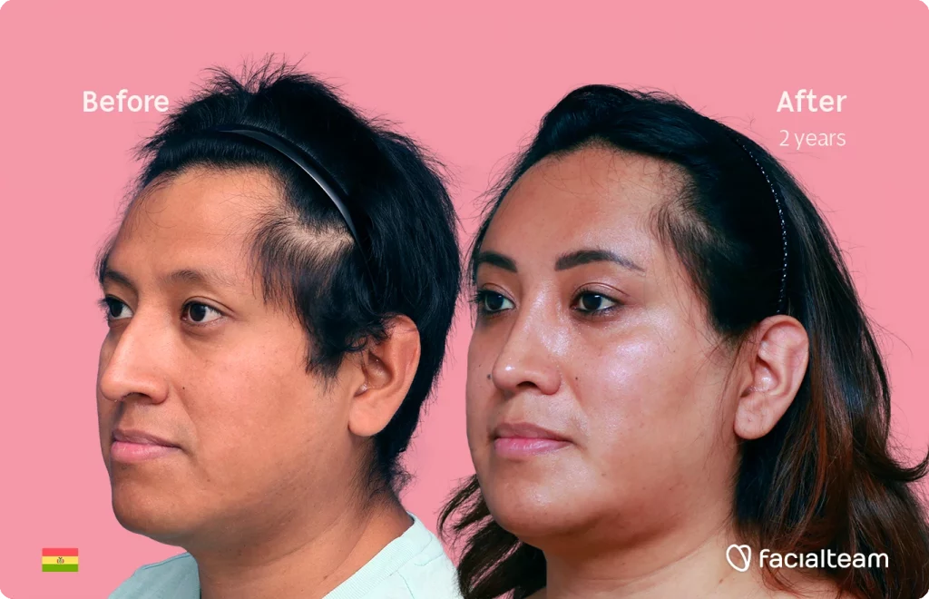 Angeled image of FFS patient Lisa showing the results before and after facial feminization surgery with Facialteam consisting of forehead, rhinoplasty and chin feminization.