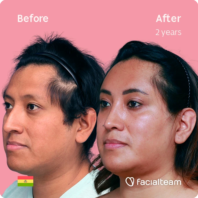 Square angeled image of FFS patient Lisa showing the results before and after facial feminization surgery with Facialteam consisting of forehead, rhinoplasty and chin feminization.
