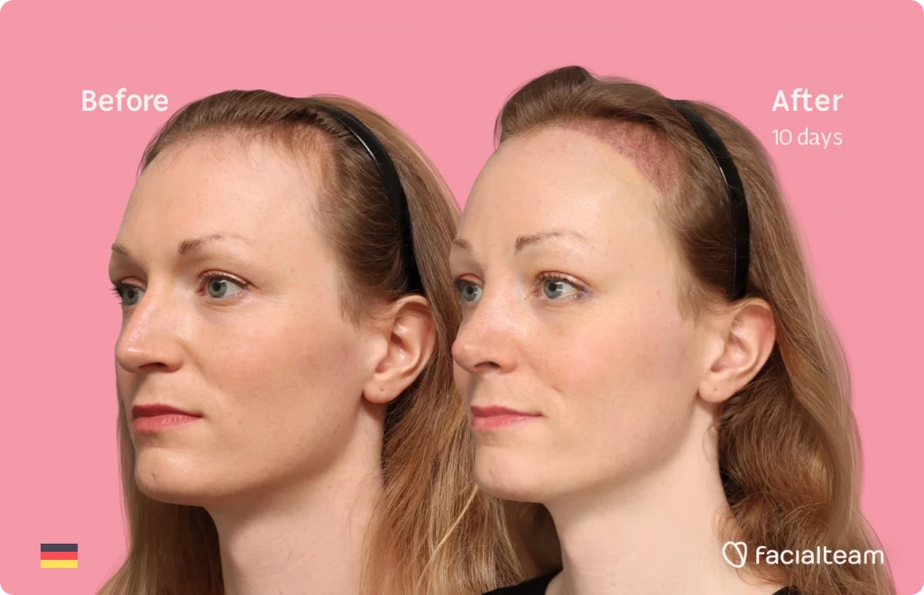 Left angeled image of FFS patient Helena showing the results before and after facial feminization surgery with Facialteam consisting of forehead with SHT and rhinoplasty feminization.