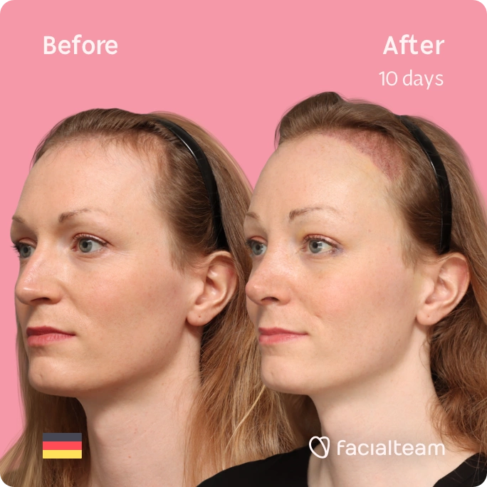 Square left angeled image of FFS patient Helena showing the results before and after facial feminization surgery with Facialteam consisting of forehead with SHT and rhinoplasty feminization.