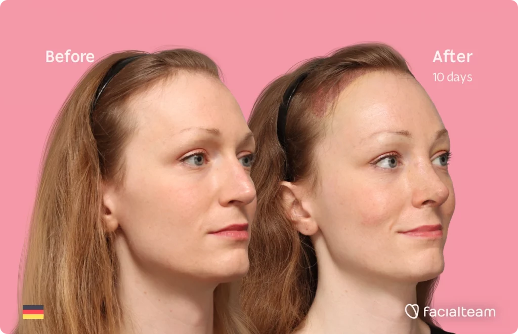 Right angeled image of FFS patient Helena showing the results before and after facial feminization surgery with Facialteam consisting of forehead with SHT and rhinoplasty feminization.