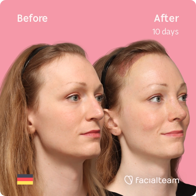 Square right angeled image of FFS patient Helena showing the results before and after facial feminization surgery with Facialteam consisting of forehead with SHT and rhinoplasty feminization.