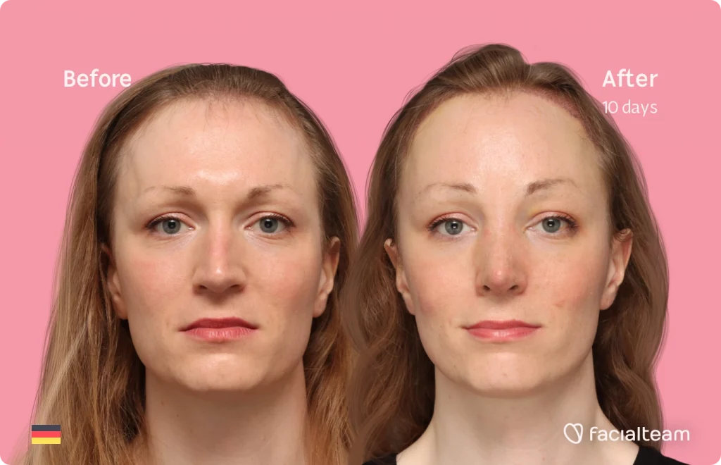 Frontal image of FFS patient Helena showing the results before and after facial feminization surgery with Facialteam consisting of forehead with SHT and rhinoplasty feminization.