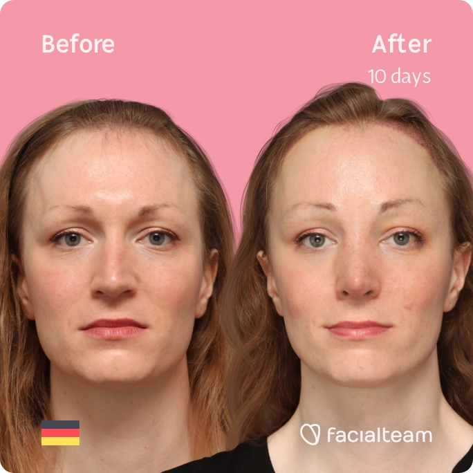 Square frontal image of FFS patient Helena showing the results before and after facial feminization surgery with Facialteam consisting of forehead with SHT and rhinoplasty feminization.