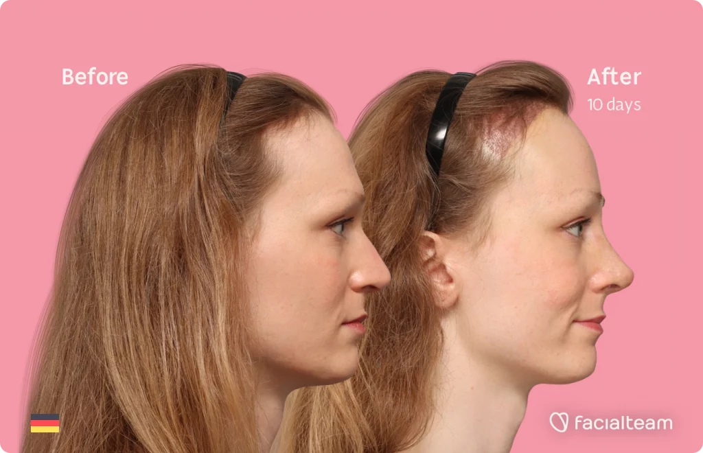 Side image of FFS patient Helena showing the results before and after facial feminization surgery with Facialteam consisting of forehead with SHT and rhinoplasty feminization.