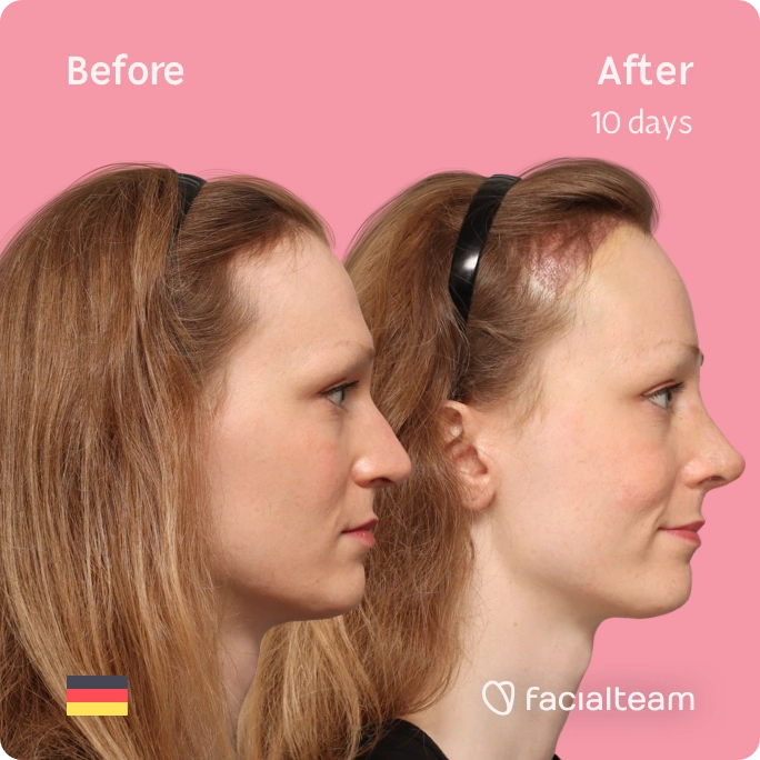 Square side image of FFS patient Helena showing the results before and after facial feminization surgery with Facialteam consisting of forehead with SHT and rhinoplasty feminization.