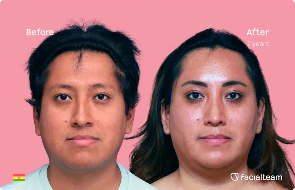 Frontal image of FFS patient Lisa showing the results before and after facial feminization surgery with Facialteam consisting of forehead, rhinoplasty and chin feminization.