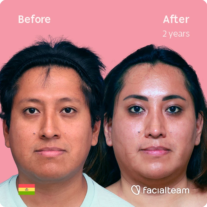 Square frontal image of FFS patient Lisa showing the results before and after facial feminization surgery with Facialteam consisting of forehead, rhinoplasty and chin feminization.