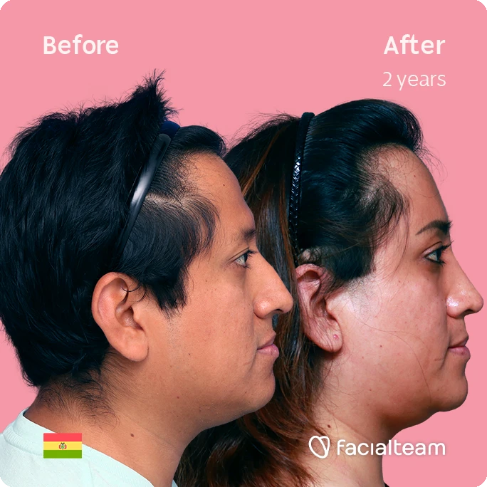 Square side image of FFS patient Lisa showing the results before and after facial feminization surgery with Facialteam consisting of forehead, rhinoplasty and chin feminization.