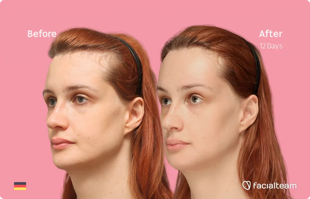 Angeled image of FFS patient Laura B showing the results before and after facial feminization surgery with Facialteam consisting of forehead, jaw and chin feminization surgery.
