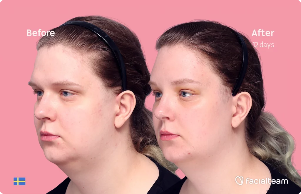 Angeled image of FFS patient Hanna showing the results before and after facial feminization surgery with Facialteam consisting of forehead feminization surgery.