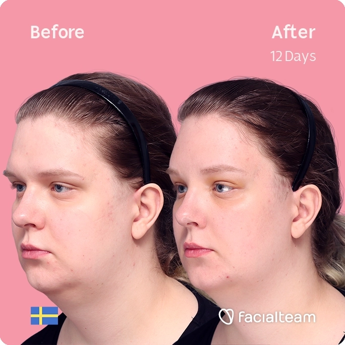 Square angeled image of FFS patient Hanna showing the results before and after facial feminization surgery with Facialteam consisting of forehead feminization surgery.