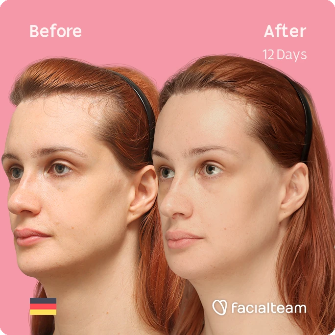 Square angeled image of FFS patient Laura B showing the results before and after facial feminization surgery with Facialteam consisting of forehead, jaw and chin feminization surgery.