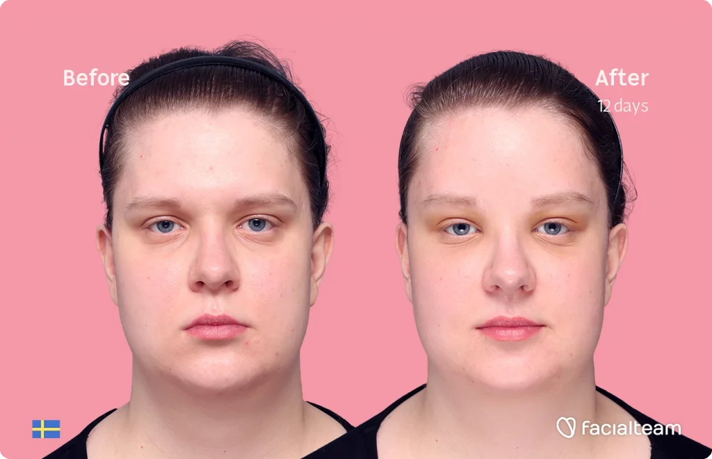 Frontal image of FFS patient Hanna showing the results before and after facial feminization surgery with Facialteam consisting of forehead feminization surgery.