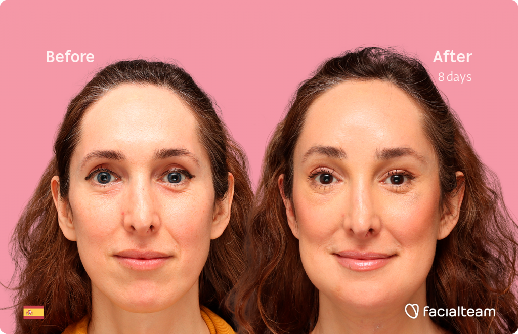 Frontal image of FFS patient Sara L showing the results before-after FFS with Facialteam of forehead, traquea shave and chin feminization surgery.
