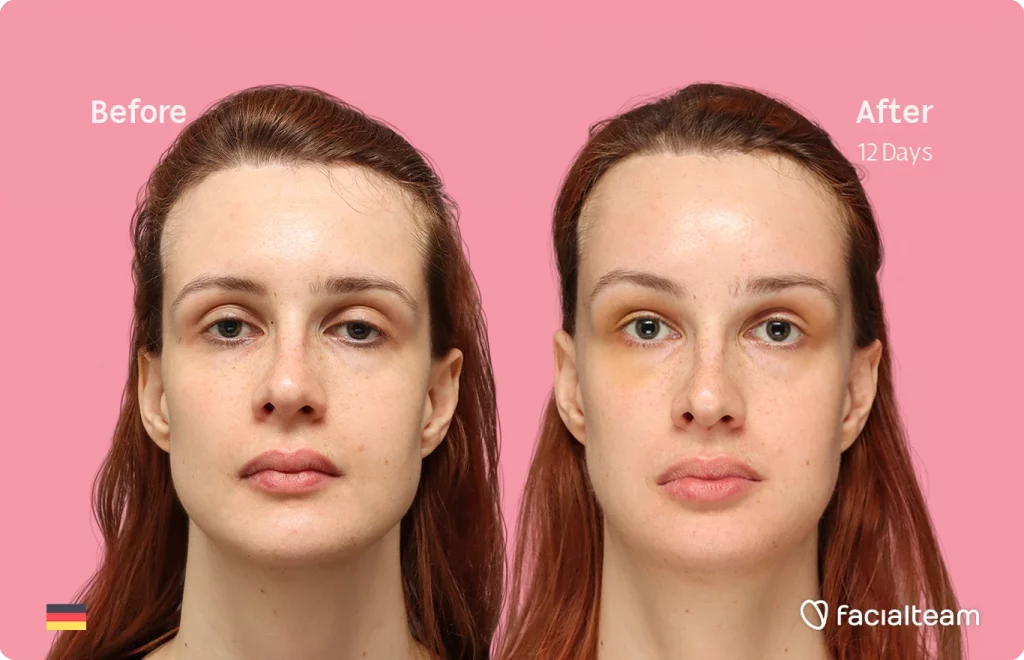 Frontal image of FFS patient Laura B showing the results before and after facial feminization surgery with Facialteam consisting of forehead, jaw and chin feminization surgery.
