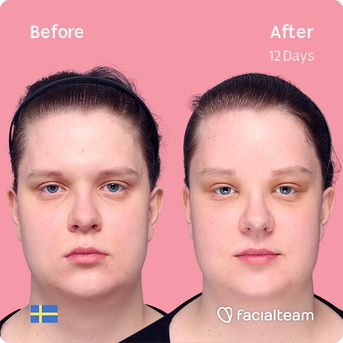 Square frontal image of FFS patient Hanna showing the results before and after facial feminization surgery with Facialteam consisting of forehead feminization surgery.