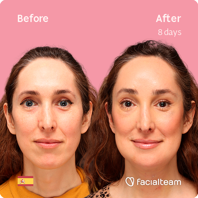 Square frontal image of FFS patient Sara L showing the results before-after FFS with Facialteam of forehead, traquea shave and chin feminization surgery.