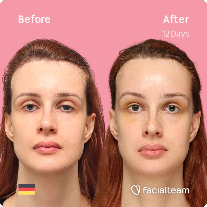 Square frontal image of FFS patient Laura B showing the results before and after facial feminization surgery with Facialteam consisting of forehead, jaw and chin feminization surgery.