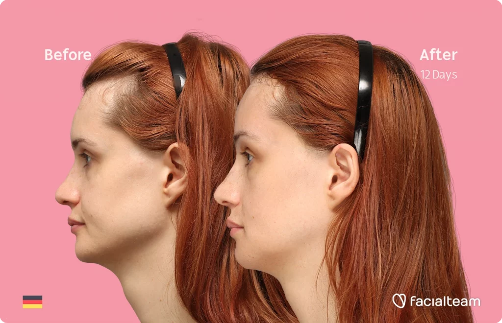 Side image of FFS patient Laura B showing the results before and after facial feminization surgery with Facialteam consisting of forehead, jaw and chin feminization surgery.
