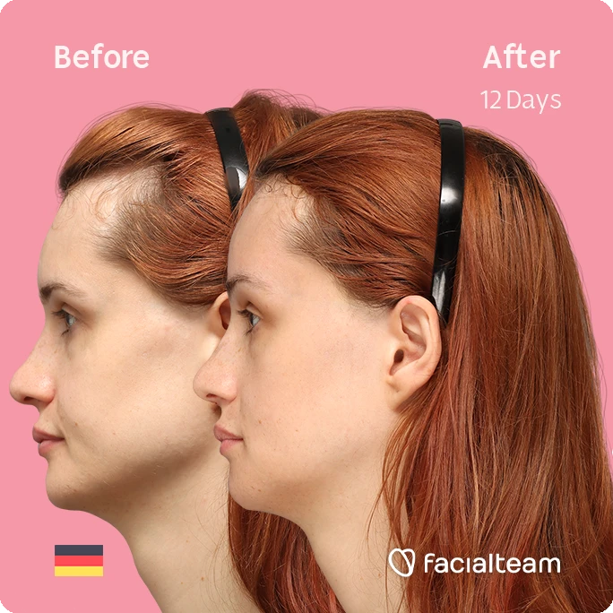 Square side image of FFS patient Laura B showing the results before and after facial feminization surgery with Facialteam consisting of forehead, jaw and chin feminization surgery.