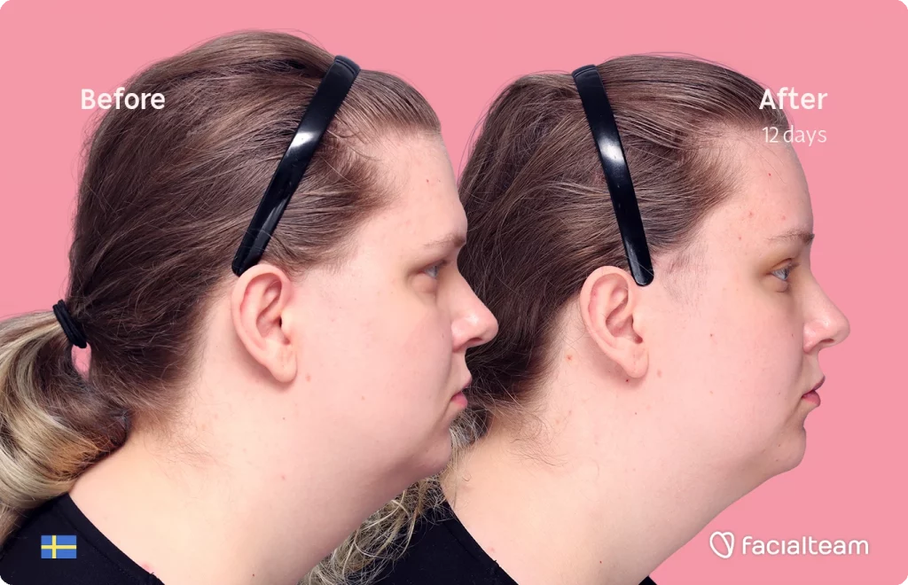 Side image of FFS patient Hanna showing the results before and after facial feminization surgery with Facialteam consisting of forehead feminization surgery.