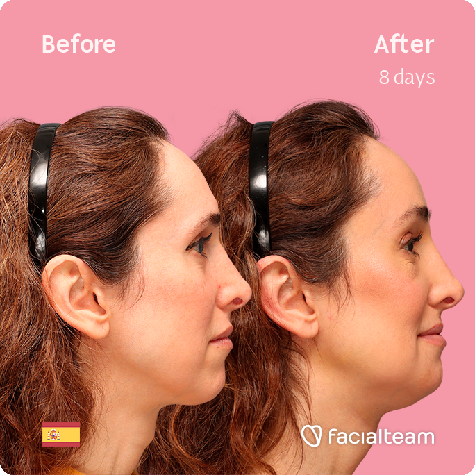 Square side image of FFS patient Sara L showing the results before-after FFS with Facialteam of forehead, traquea shave and chin feminization surgery.