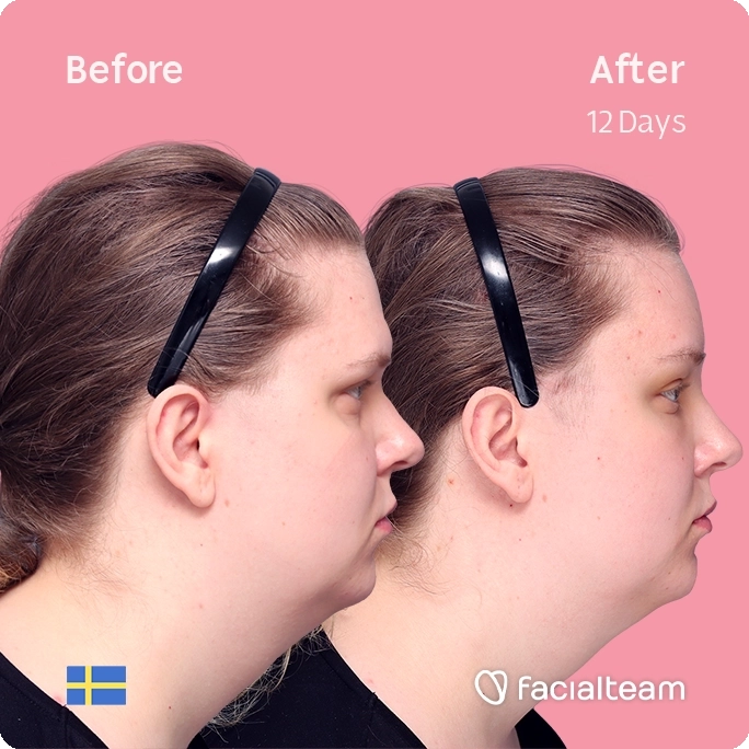 Square side image of FFS patient Hanna showing the results before and after facial feminization surgery with Facialteam consisting of forehead feminization surgery.
